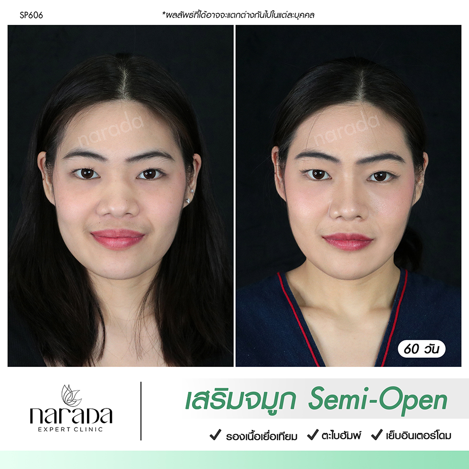 จมูกเรียวเล็ก ปลายพุ่ง ด้วยการเสริมจมูกเทคนิค Semi-Open รองเนื้อเยื่อเทียม  ที่