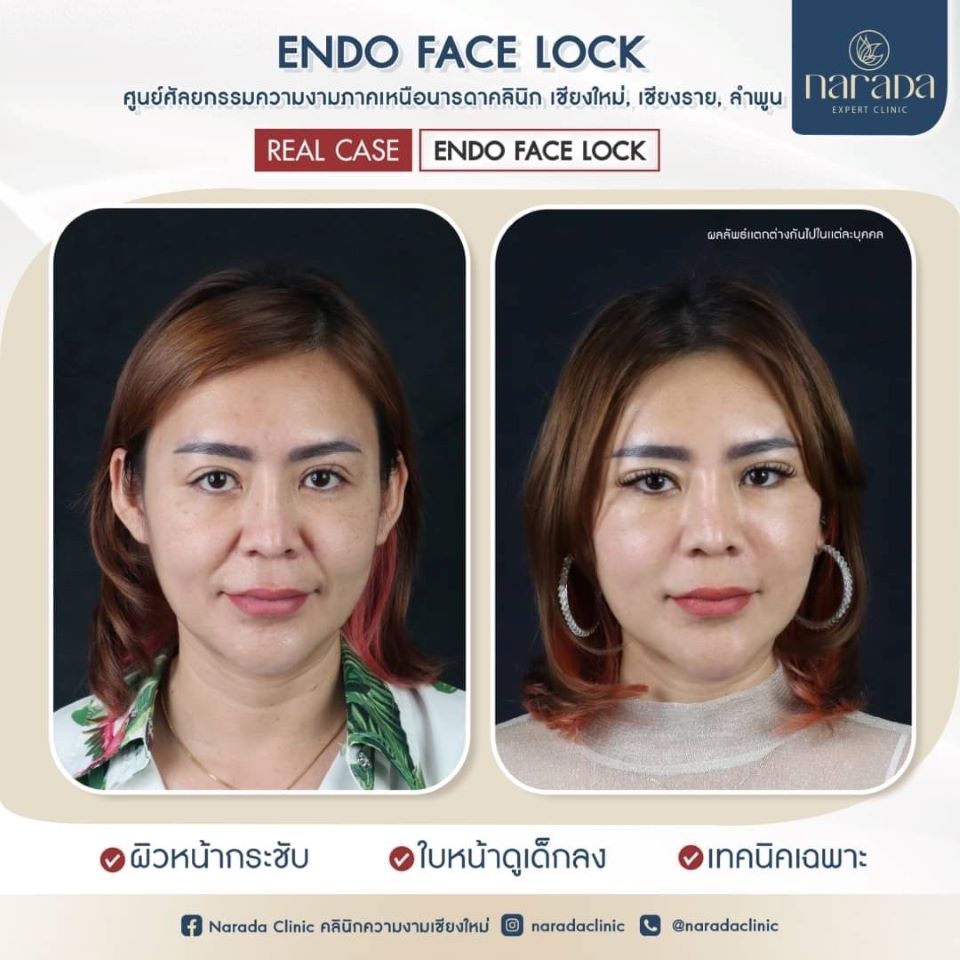 เปลี่ยนแปลงอย่างเห็นได้ชัด ใบหน้าดูอ่อนเยาว์ลง เทคนิคพิเศษผ่าตัดดึงหน้า ENDO FACE LOCK ที่นารดาคลินิก