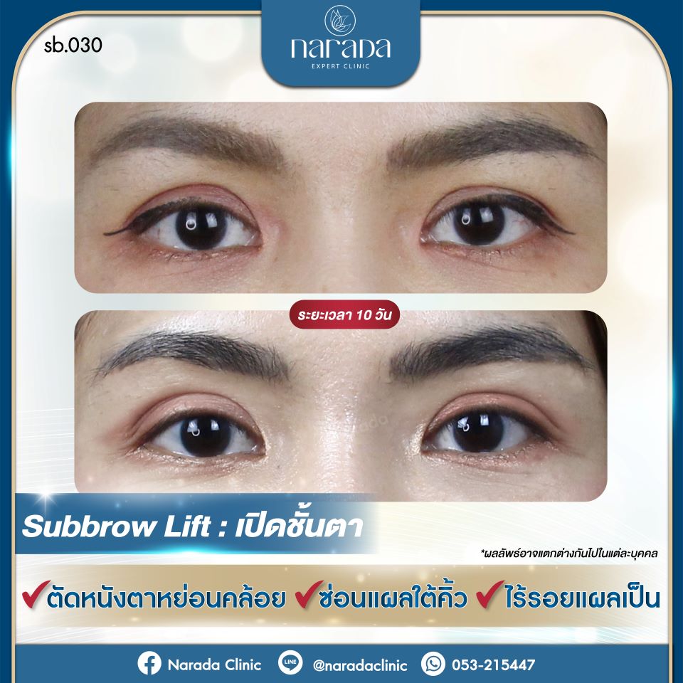 Subbrow Lift : เปิดชั้นตา เมื่อชั้นตาและหางตาเริ่มตก และมีความหย่อนคล้อย ทำให้ดวงตาดูไม่สดชื่นและมีอายุ 