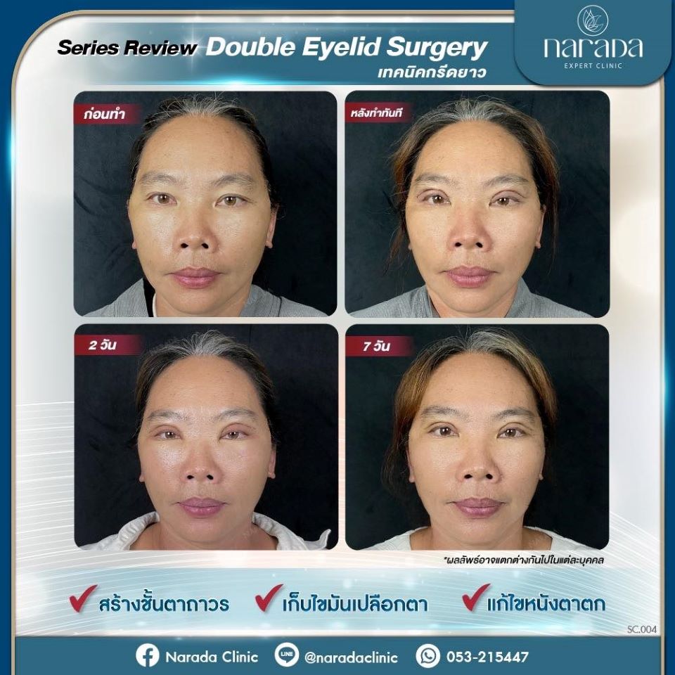 Series Review อัพเดตความสวยของชั้นตา หลังทำ Double Eyelid Surgery เทคนิคกรีดยาว