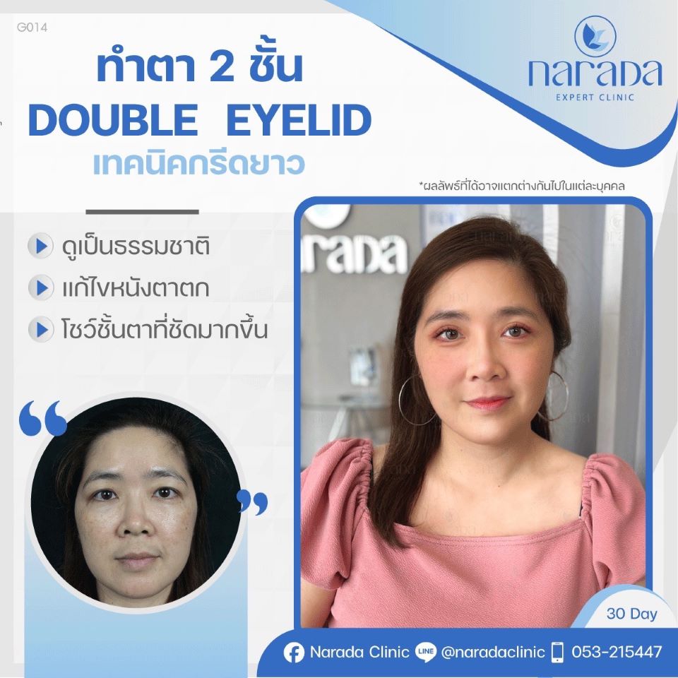 📌 Rael Case: แก้ไขปัญหาตาตกชั้นตาไม่ชัดโดยการผ่าตัดแก้ไขทำตา2ชั้น Double Eyelid เทคนิคกรีดยาว 