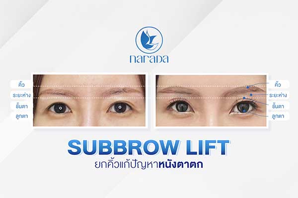 การผ่าตัดยกคิ้ว SubBrowLift
